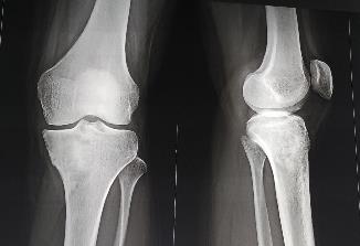 Figure 1: Radiograph of the left knee. There is a sclerotic lesion in the proximal tibia. Magnetic resonance imaging (MRI) showed that a mass occupied the same part of the left tibia (6 cm and 3.5 cm and 3.0 cm in diameter) where sclerosis was seen on the radiograph, and that soft tissues around the lesion were edematous (Figure 2). Bone scintigraphy showed an abnormal uptake on the proximal part of the left tibia. Pulmonary CT was normal.