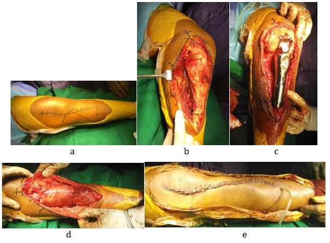 Figure 3: Intraoperative steps a) Incision b) Dissection c) Implant placement d) Coverage with flap e) closure