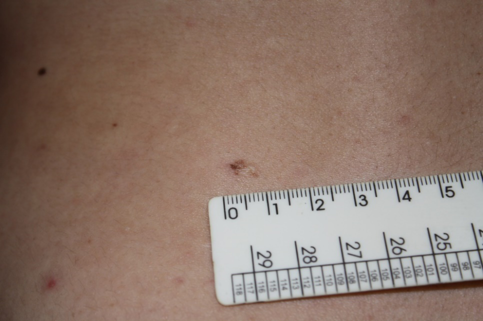 Figure 1: Scar with recurrent nevi.