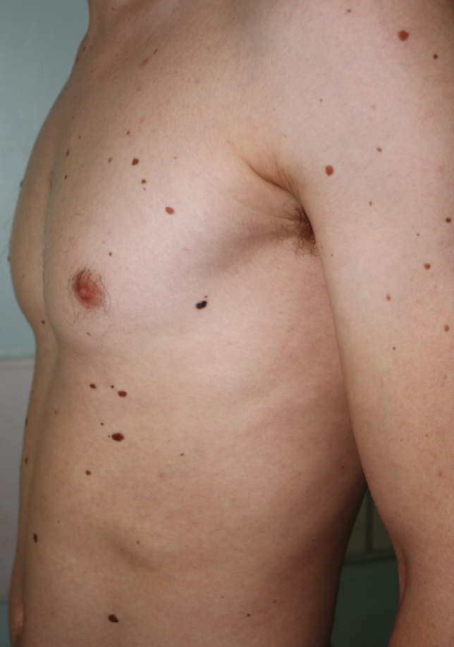 Figure 3: “Ugly Duckling” sign on the skin of the left axillary region.