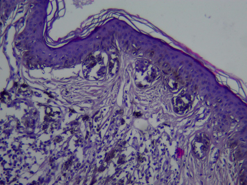 Figure 8: Histological image of invisible cells of the studied nevus.