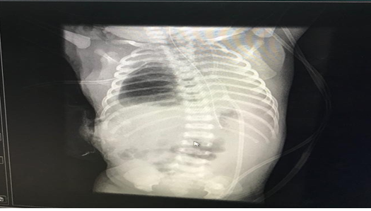 Figure 2: Chest X-ray showing improvised chest tube size 3 endotracheal tube at apex of pleural space.