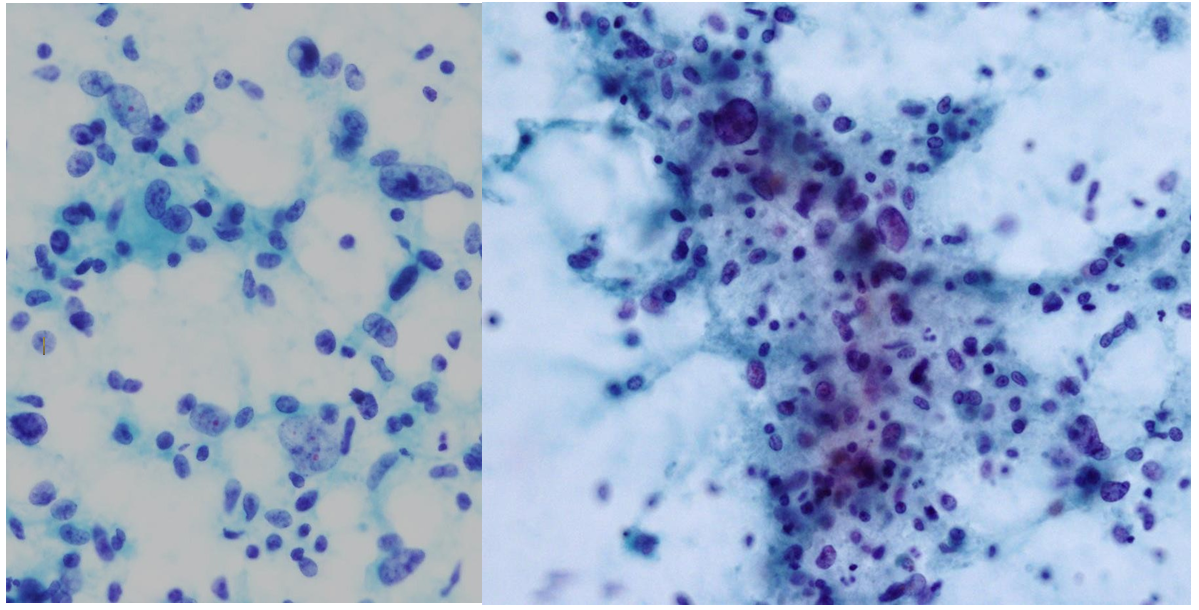 Figure 3: ** A) Cell clusters consisted of neoplastic cells with dense and hyperchromatic nuclei are observed. Glandular patterns are also noted, suggesting adenocarcinoma (Papanicolaou stain, x 80). B) Scattered neoplastic cells in various size were prominent. Highly dense and hyperchromatic nuclei are observed, suggesting sarcomas (x 80).