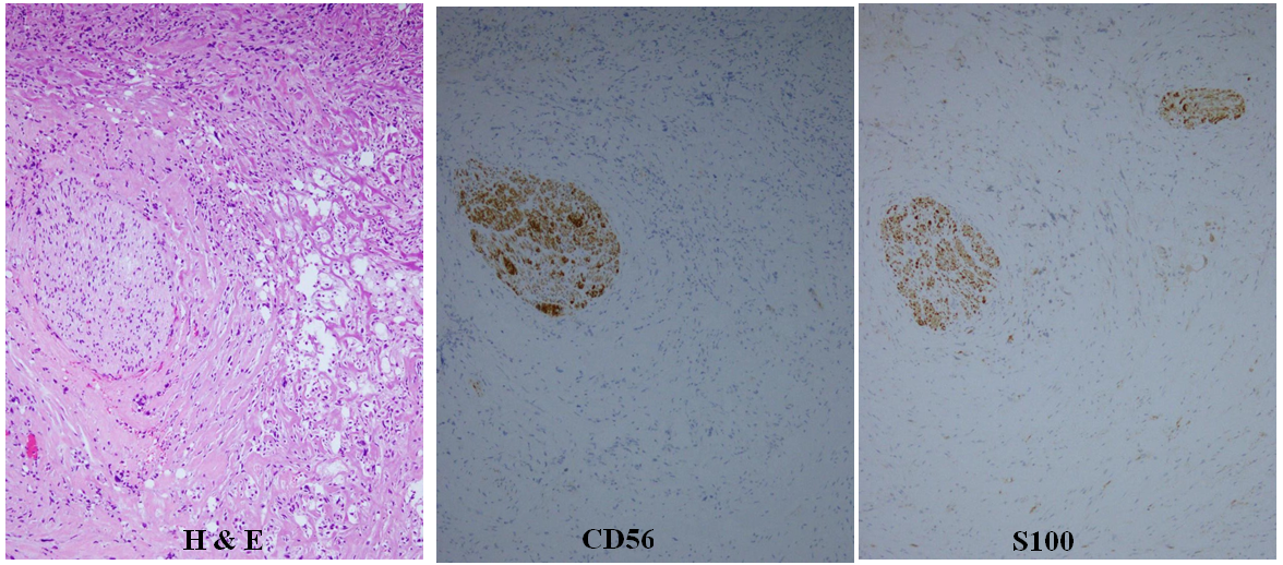 Figure 5: ** A) A part of the right ovary showed ganglio-neurinoma (H&E stain, x 50). Ganglioma and neurinoma are present, but malignant findings are not recognized. B) Immunohistochemical stainings with CD56 is positive in the neurinomatous part (sABC stain, x 50). C) Immunohistochemical stainings with S100 is also positive in the neurinomatous and some of gangliomatous parts (sABC stain, x 50).