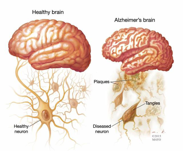 Figure 1: Healthy Brain vs. Alzheimer’s Brain.