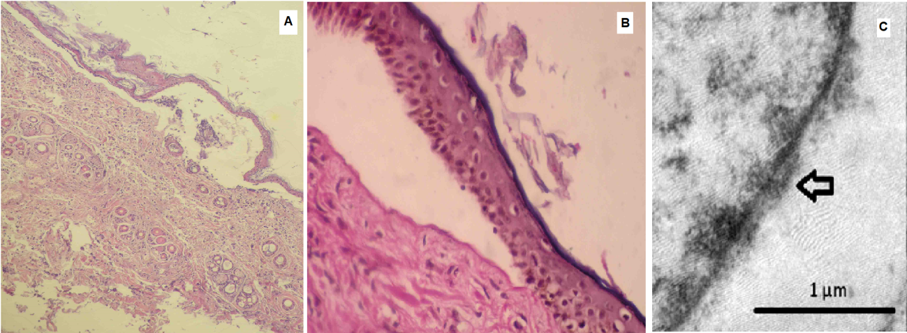 Figure 3: Histopathological examination of skin. A. Dermal-epidermal separation area. The epidermis is detached from the dermis, forming subepidermal fissures. Presence of neutrophils dispersed in the superficial and deep dermis. H/E staining, 10X objective. B. Dermo-epidermal separation forming a vesicle with cleavage in the basement membrane region. The basement membrane remains at the base of the vesicle attached to the dermis. PAS staining, 40X objective. C. Transmission electron micrograph of the skin. Cleavage of anchor filaments (arrow) attached to not well defined hemidesmosomes. Font: Errante, et al. [14].
