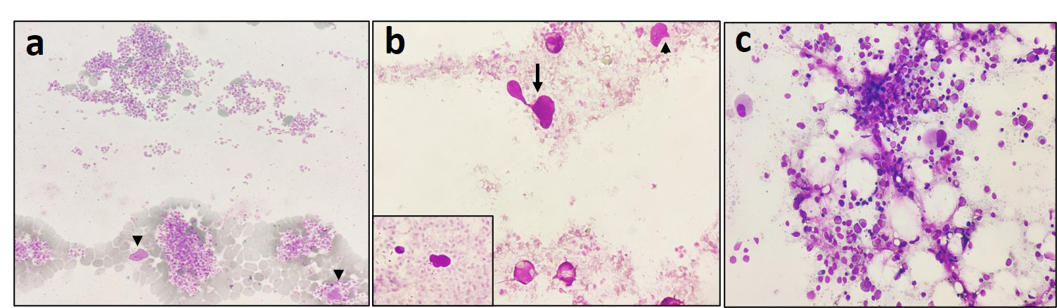 Figure 1: Peripheral blood smear from the case at the time of post induction bone marrow evaluation: Note the presence of large platelet clumps (a, x200) with scattered bare megakaryocytic nuclei (b, black arrow, and inset, x400) and nuclear fragments (black arrow head in a, b) at the tail end of the smear. Bone marrow aspirate smears (c, x400) showing low normal cellularity for age with maintained and adequate trilineage hematopoiesis and no excess blast suggestive of regenerating marrow. Leishman-Giemsa stain (a, b, c).
