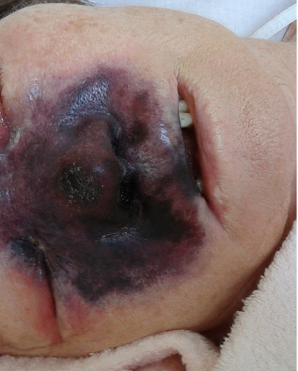 Figure 1: Patient K., 74 years old. Rhinocerebral mucormycosis (_Lichtheimia ornata_).