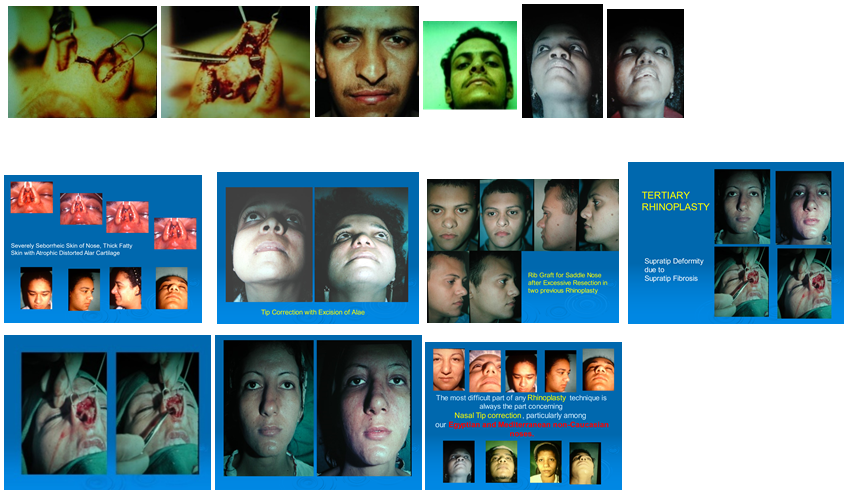 Figure 1: Therapy rhinoplastry.