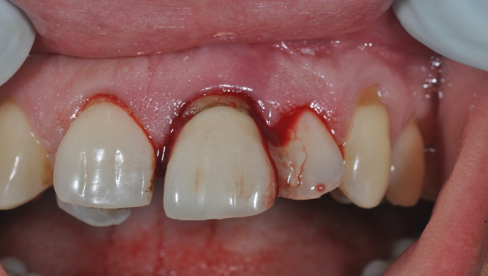 Figure 3: Post-op CBCT of Ramus (donor site).