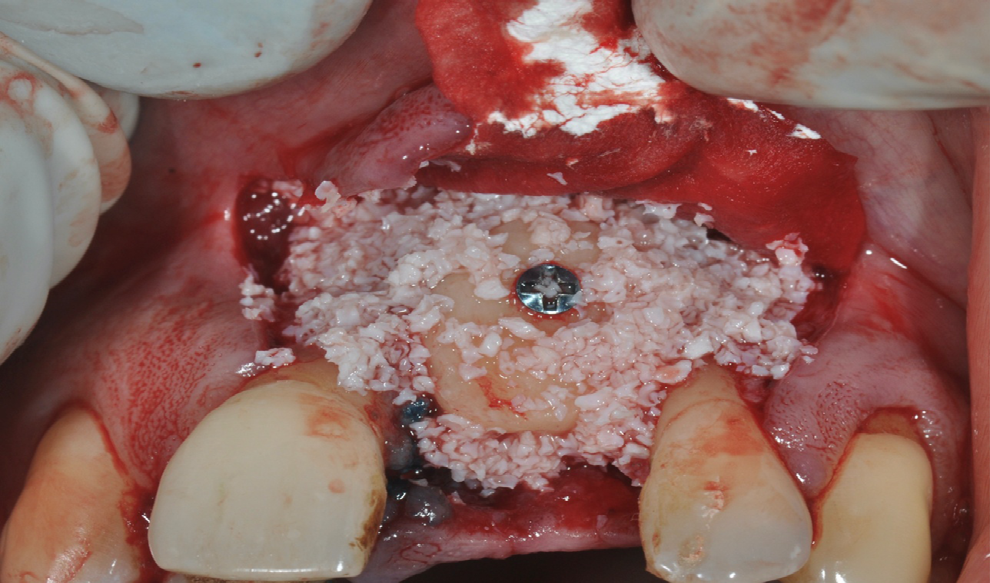 Figure 5: Resin bonded provisional crown.