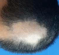 Figure 4: 3rd triamcinolone injection treatment (2/11/2021), with 10 mg of Prednisone for 2 weeks