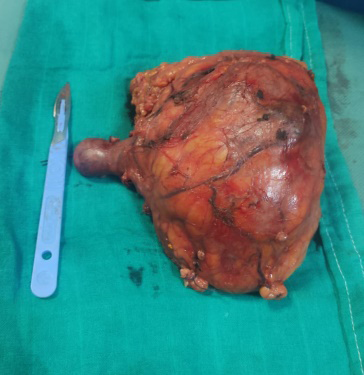 Figure 2: Nephrectomy Specimen.