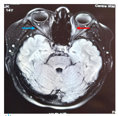 Figure 1: MRI orbital Trans axial view. Pathologic contrast enhancement and thickening in extraocular muscles: left medial rectus (