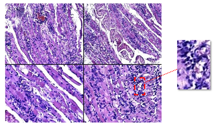 Figure 2: Haematoxylin-eosin staining of internal orbital muscle, endomysial inflammatory infiltrate.