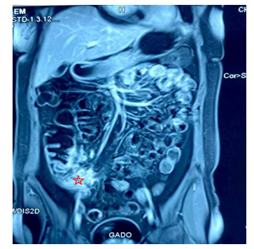 Figure 4: Coronal section of MR Enterography. Pathologic terminal ileum (