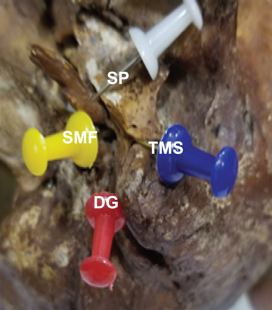Figure 2: Facial nerve trunk.