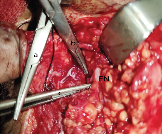 Figure 3: a. Tragal cartilage to mastoid tip b. Tragal cartilage to styloid process c. Mastoid tip to styloid process. FN= Facial nerve The second step was to make an surgical triangle that started along the long axis from the center of the tragal cartilage crossing the TP to the SP and the third step started from the MP to SP crossing the PBDM that was marked the convergent point at the SP. The predicted position of the facial nerve was located at the reference angle of the surgical triangle lateral to the SP. All references were chosen by means of dissection and palpation; not by objective measurements. Once identified, the facial nerve was freed until its trunk and its major 2 divisions were individualized.