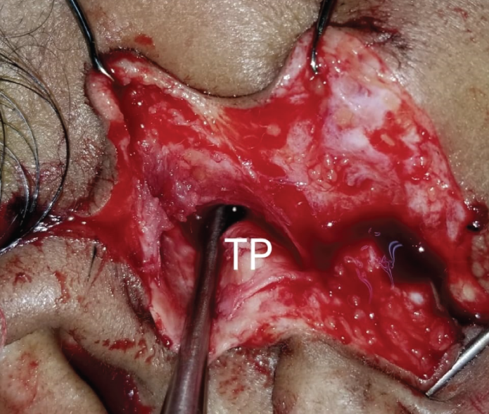 Figure 5: FN=Facial Nerve.
