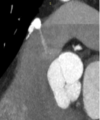 Figure 2: Reformatted MIP reconstruction showing a jet of medium contrast from an aneurysmatic sac towards the main pulmonary artery lumen in keeping with a coronary artery fistula.