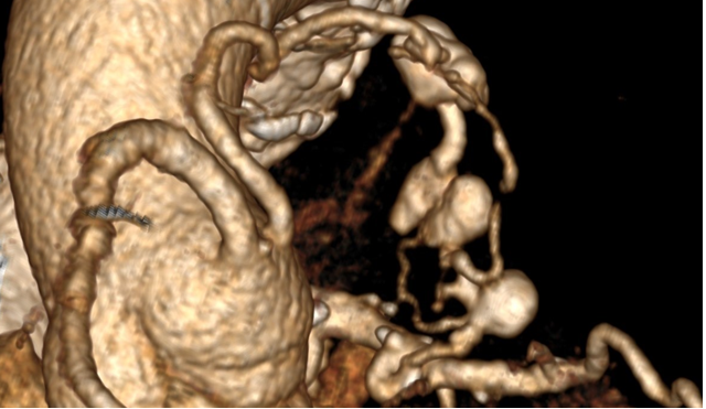 Figure 3: CTA volume rendering displaying the jet of contrast medium arising from one of the saccular aneurysms.