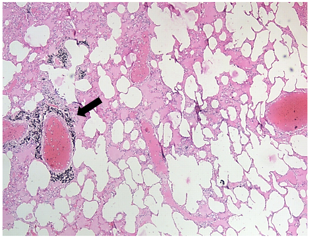 Figure 1: Thinlayer Chromatogram showing VB- Vecuronium control; 1- stomach & Intestine Samples; 2- injection-site skin puncture sample from left cubital fossa. (Solvent system-Chloroform: Acetone: Methanol = 7:2:1)