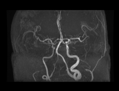 Figure 2: MR Angiography image showing diffuse long segment narrowing of right internal carotid, right middle cerebral and right anterior cerebral arteries. Also note that the right vertebral artery is hypoplastic.