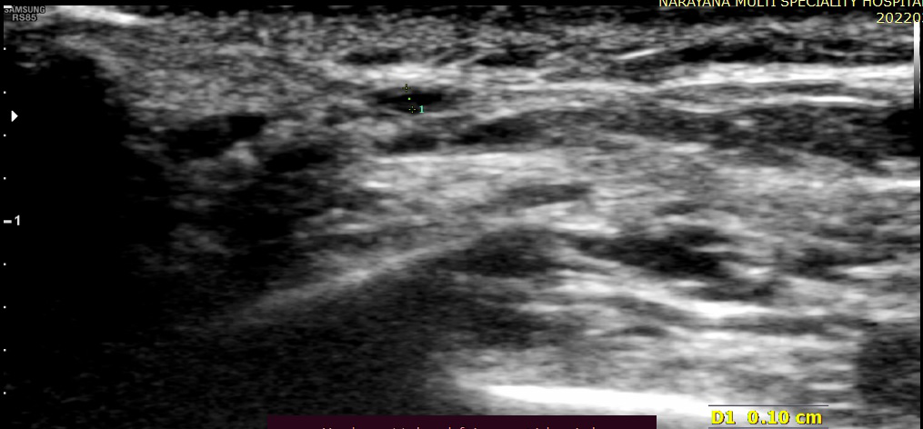 Figure 3: Doppler ultrasound image showing narrowing of right superficial temporal artery.