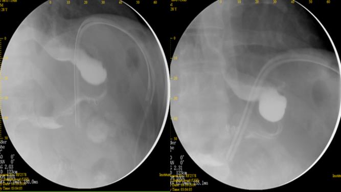 Figure 3: Case 5: Upper GI series (left) done showing gastric twistat the level of the incisura angularis, and another one (right) after management with Roux-en-Y gastric bypass.