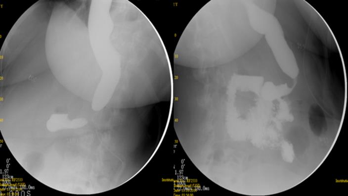 Figure 4: Case 6: UGI series done showing narrowing of the midportion of the gastric tube with dilated esophagus and stasis of contrast proximal to the stenosis.