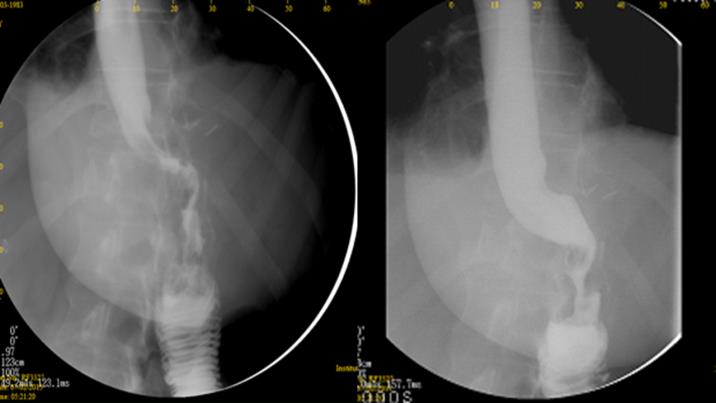 Figure 5: Case 6: Upper GI series after management with Roux-en-Y gastric bypass.