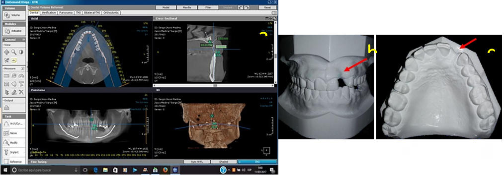 Figure 1: 3D CBCT tomography and study models, showing the different slices for the analysis of the maxillary anterior area, the vestibular collapse in the area of the upper left lateral incisor (red arrow).
