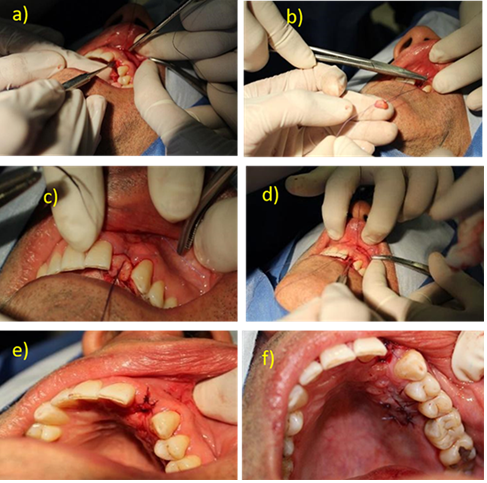 Figure 5: Placement of the connective tissue graft with the onlay technique; a) Preparation of the recipient site; b) Knotting of the connective tissue graft in the suture; c) Placement of the graft; d) Introduction of the graft; e) completion of graft placement; f) tensile suture of the donor site.