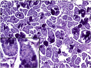 Figure 1: Serous carcinoma ovary with several psammoma bodies and papillary projections layered with ciliated columnar epithelium [5].