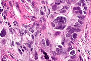 Figure 2: Serous carcinoma ovary depicting significant cellular and nuclear pleomorphism and nuclear atypia with surrounding fibrotic mesenchymal stroma [6].