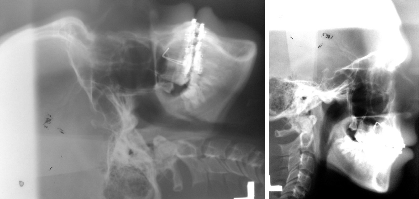 Figure 1: Unilateral complete PP is clearly evident after the digital image enhancement of the lateral cephalogram in the right image.