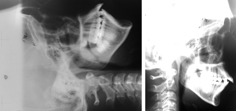 Figure 3: Complete partial PP is clearly evident after the digital image enhancement of the lateral cephalogram in the right image, whereas in the left image it was not clear whether the PP is complete bilaterally or unilaterally.