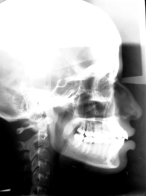 Figure 4: Bilateral partial PP is clearly evident after the digital image enhancement of the lateral cephalogram in the right image, whereas in the left image it was not clear whether the PP is partial or complete, bilaterally or unilaterally.