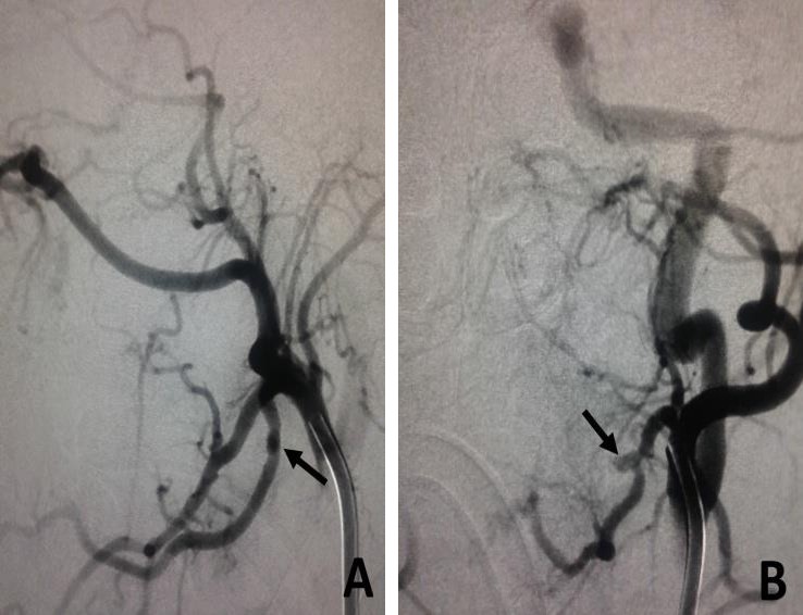 Figure 1: Lingual artery pseudo aneurysm, before embolization. A) Left external carotid artery angiogram in the lateral view showing a small double density at the proximal segment of the lingual artery, suspected to be a small post-tonsillectomy pseudo aneurysm (black arrow). B) Left external carotid artery angiogram in the anteroposterior (AP) view confirming the presence of a small lingual artery pseudo aneurysm (black arrow).