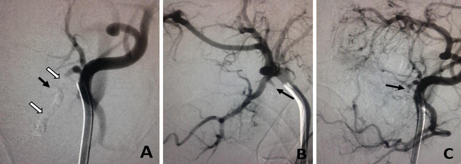 Figure 2: Lingual artery pseudo aneurysm, after embolization. A) Left external carotid artery angiogram in AP view showing the cast of the Histoacryl glue, filling the small pseudo aneurysm (black arrow), as well as the segment of the lingual artery harboring the pseudo aneurysm (white arrows), with no significant distal infiltration of the branches of the artery. B) Left external carotid artery angiogram in the lateral view showing occlusion of the pseudo aneurysm and the lingual artery. The stump of the lingual artery can be seen (black arrow). C) Left external carotid artery angiogram in the AP view showing occlusion of the pseudo aneurysm and the lingual artery. The stump of the lingual artery can be seen (black arrow). Three of the patients had active bleeding, which was evident via contrast extravasation during the diagnostic angiogram, and were controlled during the interventional procedure using tonsil compression forceps. The contrast extravasation disappeared after the injection of the embolizing material. Moreover, the removal of the forceps and examination of the tonsil bed after embolization was essential to confirm the success of the procedure. Furthermore, an immediate surgical exploration and ligation of the injured faciolingual trunk was necessary to deal with a failed embolization in one of these patients.