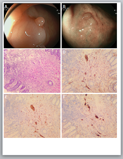 Figure 1: Colonoscopy revealed a sessile polyp in the rectum, in size approximate 5 mm (A): Which was further defined by blue laser imaging technology. (B): Hematoxylin and eosin staining showed enlarged nerve bundles with spindle cells and ganglion cells. (C): Positive immunohistochemical staining for S100, SOX-10, and Syn was demonstrated (D-F).
