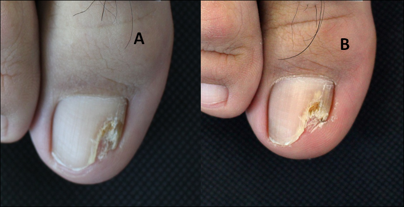 Figure 2: Clinical images of onychomycosis treated with long-pulsed 1064-nm Nd:YAG laser. (A) Before treatment. (B) After treatment.