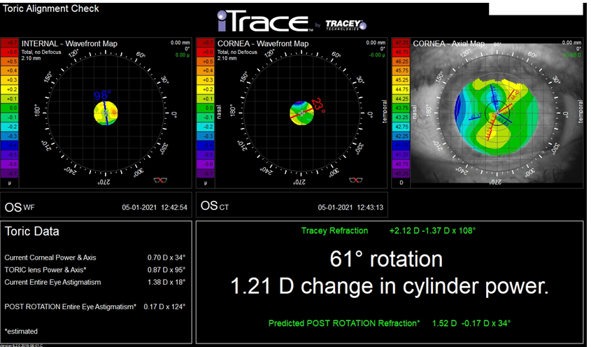 Figure 2: The result of an eye examination after implantation of a PanOptix spherical lens using the Toric Alignment Check module. The value of Toric lens Power & Axis® clearly indicates that the toric lens was implanted. Its positioning in the eye is inconsistent with the axis of corneal astigmatism.