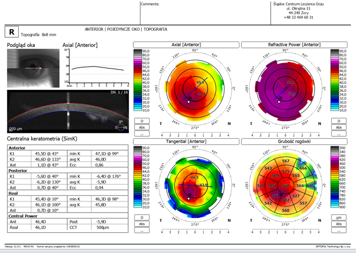 Figure 3: Result of an eye examination using the SOCT Copernicus REVO device, a module for the assessment of total corneal astigmatism, including anterior as well as posterior astigmatism of the cornea. The real value of the astigmatism in this eye is 0,7Dcyl 7°.