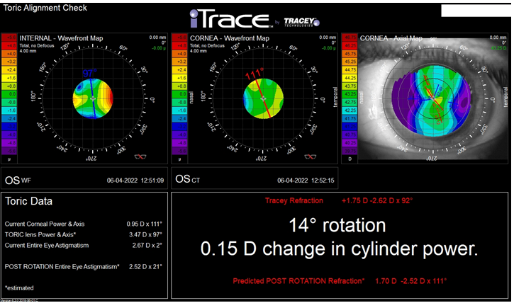 Figure 7: A result obtained with the same, TAC module, but after implantation of a toric lens. The value of the Toric lens Power & Axis® is 3,47Dycyl 97°. This result, apart from showing different values, does not differ in any way from that obtained after implanting a spherical lens.