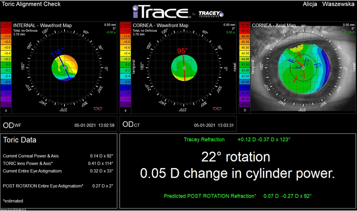 Figure 8: A result obtained with TAC madule, after implantation of spherical, multifocal lens, model PanOptix. The obtained value for the Power & Axis® toric lens, although very small, may still suggest the presence of a toric lens in the eye.