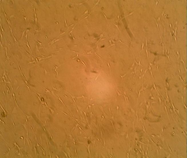 Figure 2: Benign familial neurofibroma cell culture (4.60 x103/ml) exhibiting dense cell population bipolar and tripolar cells (up and down arrows) that is close to being confluent after the addition of bFGF (x200).