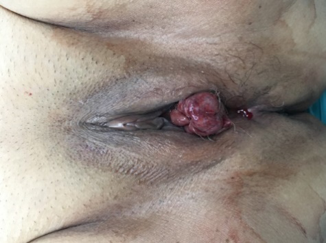 Figure 1: Urethral malignant melanoma presenting as a mass protruding from urethral meatus with contact bleeding.