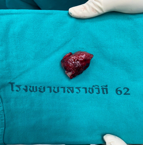 Figure 3: Operative findings after wide excision and distal urethrectomy.