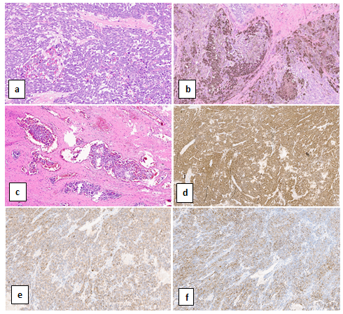 Figure 4: Specimen of urethral mass consists of a dark brown rubbery polypoid mass.